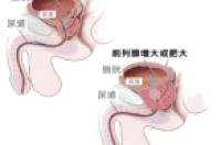 成都川蜀血管病医院：夏正超医生引领前列腺动脉栓塞术的卓越之旅-环保卫士